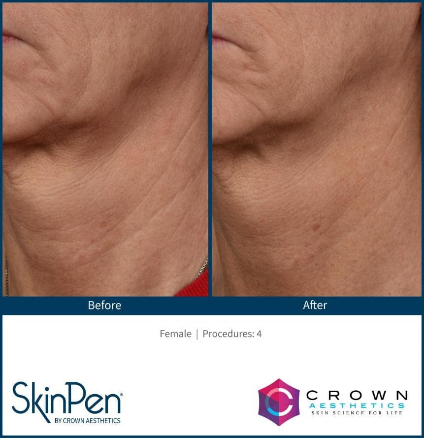 before and after SkinPen microneedling at Waltzman Institute Plastic Surgery