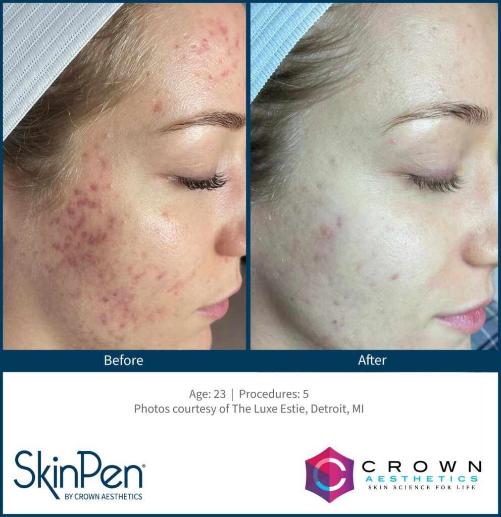before and after female patient SkinPen microneedling at Waltzman Institute Plastic Surgery