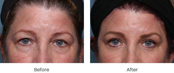 Brow Reshaping Long Beach & South Bay