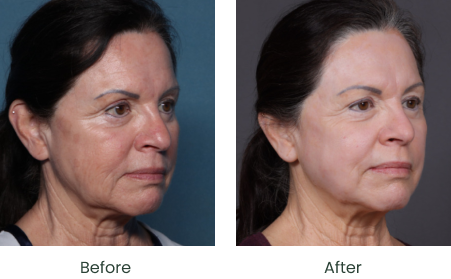 Facial Rejuvenation Long Beach & South Bay