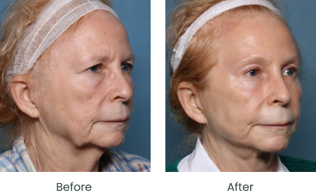 Facial Rejuvenation Long Beach & South Bay