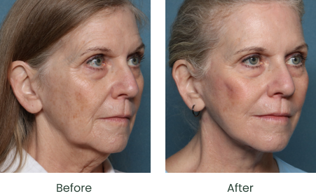 Facial Rejuvenation Long Beach & South Bay