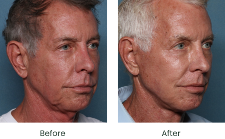 Ozempic Face Long Beach | Waltzman Plastic Surgery South Bay