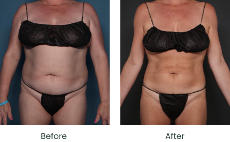 fda semaglutide US FDA accepts Novo Nordisk's application for oral Wegovy for weight loss