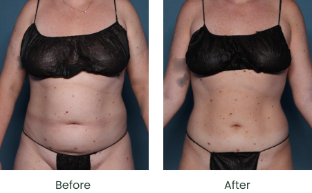 nad injections with semaglutide Semaglutide & Tirzepatide Long Beach CA | Weight Loss Injections